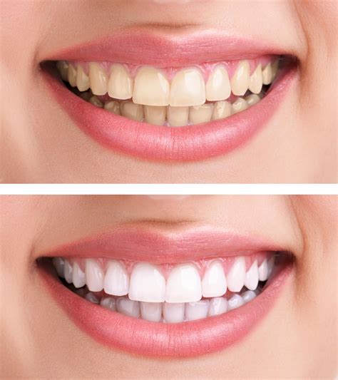 Teeth Whitening Treatment Consultation Secrets Revealed