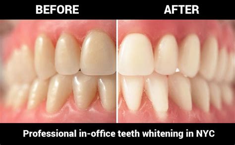Teeth Whitening Treatment Cost in NYC Revealed