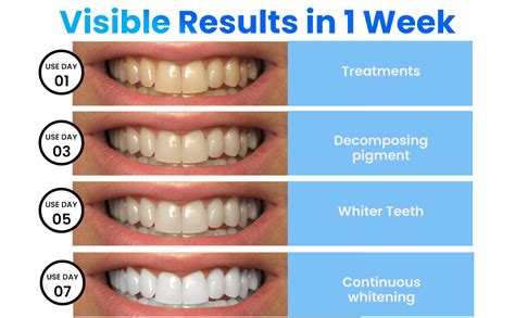 Teeth Whitening Treatment Recovery Time Uncovered Professional Insights and Tips