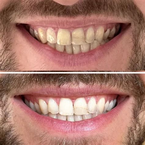 Best Teeth Whitening Treatment Reviews Revealed