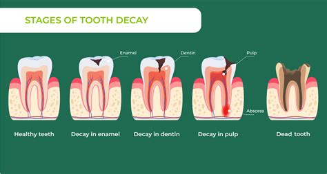 Best Practices to Defeat Tooth Decay
