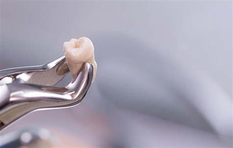 Unveiling the Real Tooth Extraction Cost Los Angeles Residents Pay