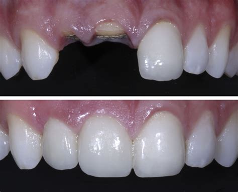 Tooth Protection Before and After: Amazing Results!