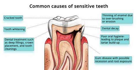 Revealing Tooth Sensitivity Causes: Quick Insight