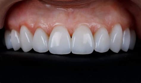 Veneers for Teeth: Lasting Smile Success