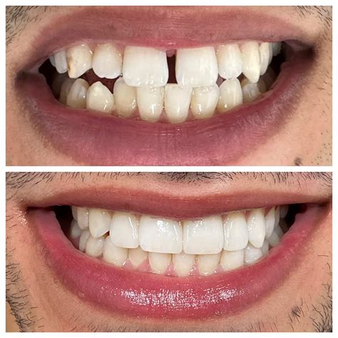 Best Veneers for Teeth Near Me: Transform Your Smile