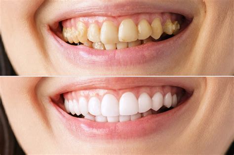 Discover Affordable Veneers for Teeth with Flexible Payment Plans