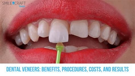 Uncover the Veneers for Teeth Price That Transforms Smiles Without Breaking the Bank