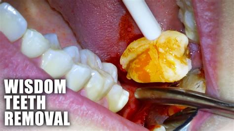 Wisdom Tooth Removal 24 Hour Service: Fast Relief Awaits