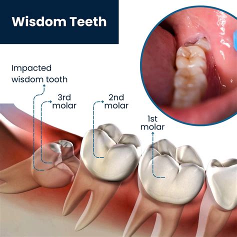 Wisdom Tooth Removal: Advanced Treatment Breakthrough