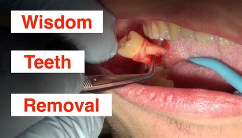 Wisdom Tooth Removal Los Angeles: Top Surgeons Guide 2023