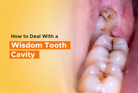 Top Wisdom Tooth Removal Reviews: Real Patient Experiences